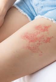 Image result for herpes zoster