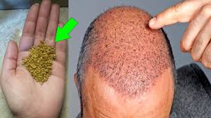 ضعيها على أماكن الصلع سينمو الشعر فيها وتختفي الفراغات في 10 ايام Youtube Beauty Recipes Hair Beauty Recipe Hair Care Oils