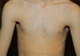 Pectus excavatum is a structural deformity of the anterior thoracic wall in which the sternum and rib cage are shaped abnormally. Pectus Excavatum Springerlink