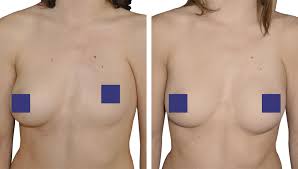 Poland syndrome is a health condition in which the muscles present on one side of the body are either underdeveloped or absence of breast from the affected side. Results Anatomikmodeling