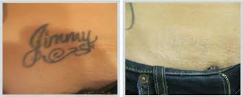 Do not get tattoo removal from anyone who isn't licensed. Tattoo Removal Stats Laser Tattoo Removal