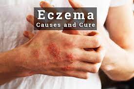How to cure eczema fast at home. Eczema Treatment Causes And Symptoms How To Cure Eczema Fast