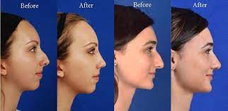 Insurance will typically only cover the functional part of your operation. Rhinoplasty Ohsu