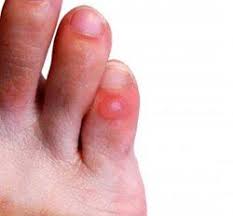 Mantener los pies hidratados con cremas específicas siempre. Remedios Caseros Naturales Para Las Ampollas