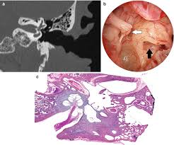 Image result for Bacterial Labyrinthitis