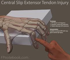 Image result for Elson Extensor Tendon Test