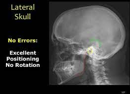 Good Lateral Skull Radiology Student Radiologic Technology Radiology