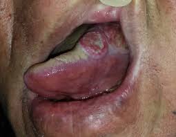 Image result for white cancer on tongue)