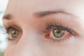 आंखों की एलर्जी के लक्षणों के लिए मुझे विशेषज्ञ से कब परामर्श लेना चाहिए? &ndash;  डेलावेयर नेत्र देखभाल केंद्र