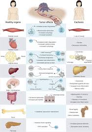 Image result for Cachexia in Cancer