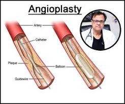 The coronary artery is located on the surface of the heart. Angioplasty In Diabetes Special Considerations