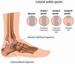 Anterior Talofibular Ligament Tear Sprain Causes Symptoms Diagnosis Treatment