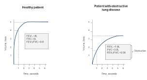 Image result for Pulmonary Function Test