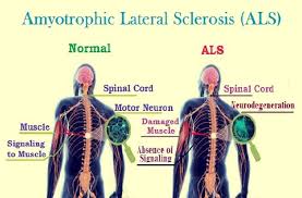 Als (amyotrophic lateral sclerosis) is an incurable condition that can cause symptoms such as muscle weakness, atrophy of muscles, and spasticity, among other things. Amyotrophic Lateral Sclerosis Als Also Known As Lou Gehrig S Disease Is A Motor Neuron Disease Amyotrophic Lateral Sclerosis Diagnosis Lou Gehrigs Disease