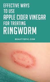 How To Use Apple Cider Vinegar For Ringworm Apple Cider Vinegar For Skin Apple Cider Vinegar Remedies Cider Vinegar