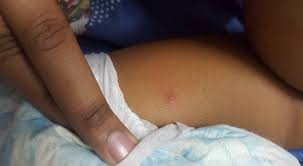 Symptoms of chickenpox begin to appear with shivering, fever, abdominal pain, headache and a general state of malaise. Chicken Pox Kering Dalam 7 Hari Ibu Ini Kongsi Tips Cara Penjagaannya