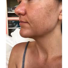 Sweet potatoes, carrots, fish, bell peppers and green leafy vegetables are some of the best sources of vitamin a. How I Fixed My Horrible Skin After 20 Years Of Tanning Acne Celery And The City