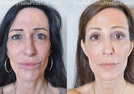 Check spelling or type a new query. Browlift Before After Photos