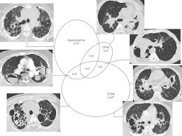 There are several different types of aspergillosis. Chronic Pulmonary Aspergillosis Complicating Sarcoidosis European Respiratory Society