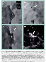 As fluoroscopy remains an important adjunct to transoesophageal echocardiography, especially in complex defects and complications, procedures. Different Patent Foramen Ovale Closure Techniques In Varying Anatomies