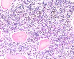 Cada uno de los padres tiene 1 copia del gen anormal sin manifestar ningún signo de la enfermedad. Bone Marrow Involvement In Niemann Pick Disease 5