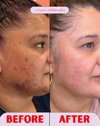 Lumecca arms before and after one treatment! Treat yourself this holiday  season to a glowing, even complexion