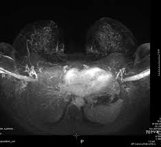 Some benign conditions such as fibrocystic disease can look like cancer. Mammographically And Mri Occult Breast Cancer Bmj Case Reports