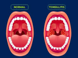 Image result for Tonsillitis
