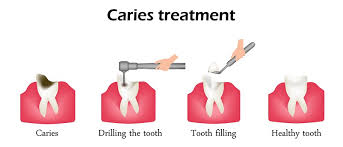 + procedures), understanding dental filling cost in nigeria what you need to know about tooth fillings when. Dental Fillings Procedure Details Recovery Time Cost Info