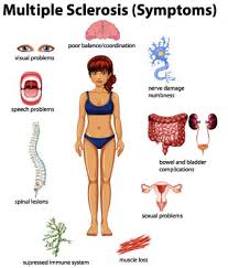 In ms , the immune system attacks the protective sheath (myelin) that covers nerve fibers. Multiple Sclerosis Ms Dr Diane Brain Health