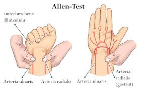 Raynaud Syndrom Was Hilft Gegen Das Plotzliches Erblassen Der Finger Liebscher Bracht