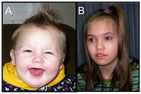 Phenotypic and Molecular Convergence of 2q23.1 Deletion Syndrome with Other  Neurodevelopmental Syndromes Associated with Autism Spectrum Disorder
