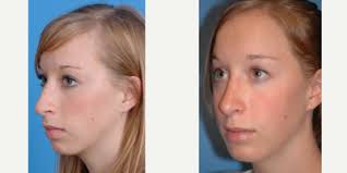 Benjamin C. Marcus, MD, Board Certified Facial Plastic Surgeon