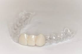 Moreover, a flipper easily pops in and out of your mouth so, in the event of discomfort, you can easily take a break. Essix Retainers Vivant Dental