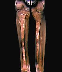 Image result for Osteomyelitis