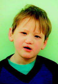 Extreme variability of expression of a Sonic Hedgehog mutation: attention  difficulties and holoprosencephaly