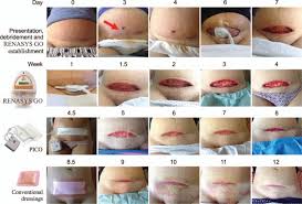 Negative Pressure Wound Therapy Aids Recovery Following Surgical Debridement Due To Severe Bacterial Cellulitis With Abdominal Abscess Post Cesarean A Case Report Care Compliant Abstract Europe Pmc