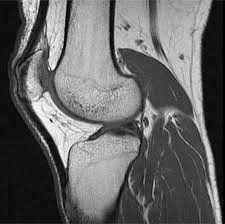 It is the largest synovial joint in the body and allows flexion and extension of the leg as well as some rotation in the flexed position. Accessory Muscles Of The Knee Radsource