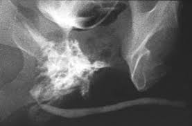 Image result for Retrograde Urethrogram