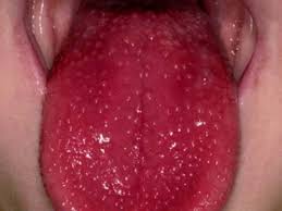 Sustantivo de género exclusivamente femenino, que lleva los artículos la o una en singular, y las o unas en plural. Scarlattina Sintomi E Foto Per Riconoscerla Passione Mamma
