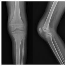 Image result for Osteomyelitis XRay