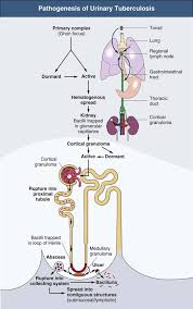 Image result for Genitourinary Tuberculosis