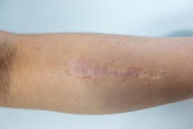 The fabrique nationale scar series of rifles have appeared in the following television series and video games used by the following actors: Cream Used To Treat Skin Cancers Could Stop Scars In Their Tracks