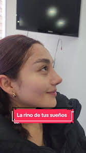 Rinoplastia Ultrasónica: Transformación y Resultados