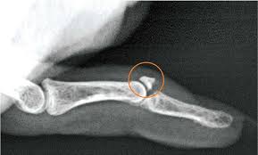 Medical aluminum mallet finger fracture extension splint types. Mallet Finger Baseball Finger