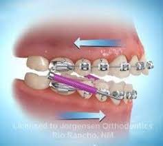 Where Has All The Headgear Gone Teeth Braces Orthodontics Metal Braces