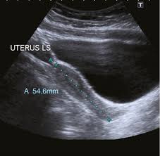 A transabdominal (ta) evaluation and a transvaginal (tv) / endovaginal (ev) evaluation. Ultrasound Of Pelvic Anatomy Scanning Techniques And Normal Findings Chapter 4 Ultrasound In Reproductive Healthcare Practice