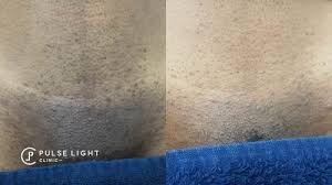 Laser hair removal is a process where light (aka the laser beams) is directed onto your skin in little pulses, targeting and heating up the hair follicle to destroy a portion. Laser Hair Removal Dark Skin Pulse Light Clinic London