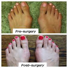 Combine the following sentences using until, till, before or after. Documenting My Double Bunionectomy Bunion Surgery Experience Includes Many Pictures Following The Progress Of My Bunion Surgery Bunion Foot Surgery Recovery
