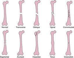 Image result for Fracture Types